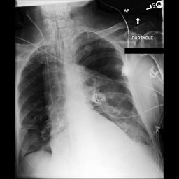 Chest X-ray provided to the agent for Multimodal · 24-h Decompensation